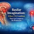 Basilar Invagination: A Rare CVJ Condition That Can Compress the Brainstem